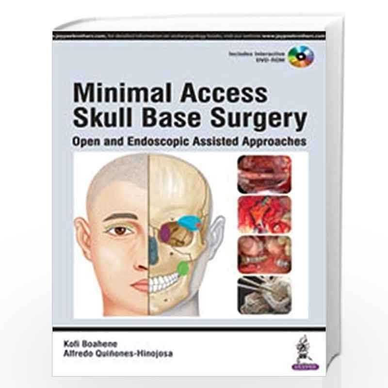 Minimal Access Skull Base Surgery Open and Endoscopic Assisted Approaches with DVD-ROM by BOAHENE KOFI Book-9789351529347