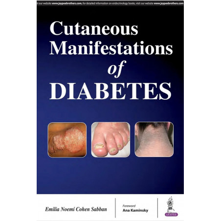 Cutaneous Manifestations of Diabetes book by Emilia Noemí Cohen Sabban