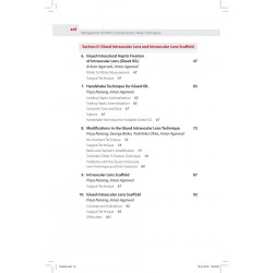MANAGEMENT OF PHACO COMPLICATIONS NEWER TECHNIQUES INCLUDES 2 INT.DVD-ROM book by Agarwal Amar - Additional Image 7