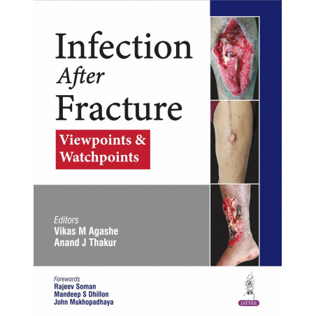 Infection After Fracture: Viewpoints & Watchpoints for Orthopedic Surgeons, Trauma Surgeons & PG Trainees | PICASSO Protocol…
