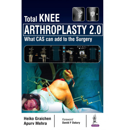 Total Knee Arthroplasty 2.0 book by Apurv Mehra, Heiko Graichen