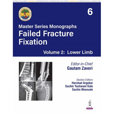 BOS Master Series Monographs (Volume 6) Failed Fracture Fixation Volume 2: Lower Limb book by Gautam Zaveri, Harshad Argekar