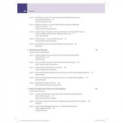 BOS Master Series Monographs (Volume 5) Failed Fracture Fixation Volume 1: Upper Limb book by Gautam Zaveri, Dipit Sahu - Additi