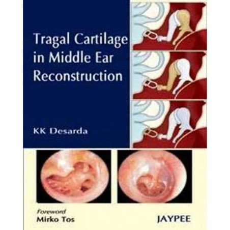 Tragal Cartilage in Middle Ear Reconstruction for ENT Surgeons and Otolaryngologists | Surgical Monograph on Reconstructive…