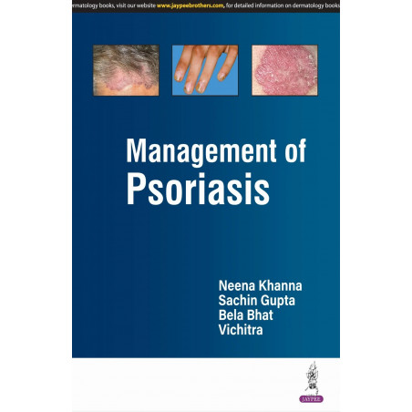 MANAGEMENT OF PSORIASIS book by Neena Khanna, Sachin Gupta
