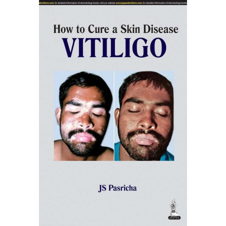 How to Cure a Skin Disease Vitiligo book by JS Pasricha