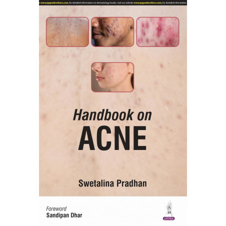 HANDBOOK ON ACNE book by Swetalina Pradhan, Rashid Shahid