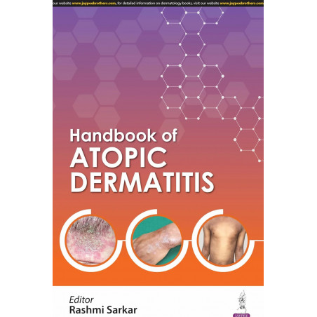 HANDBOOK OF ATOPIC DERMATITIS book by Rashmi Sarkar