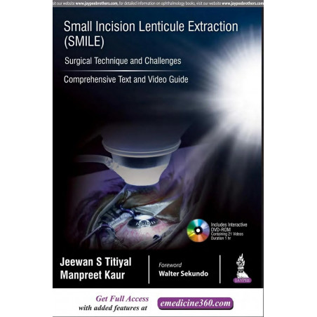 SMALL INCISION LENTICULE EXTRACTION (SMILE) SURGICAL TECHNIQUE AND CHALLENGES:COMPREHENSIVE TEXT book by Jeewan S Titiyal, M…