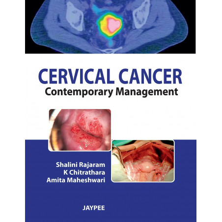 Cervical Cancer: Contemporary Management book by Shalini Rajaram, K Chitrathara