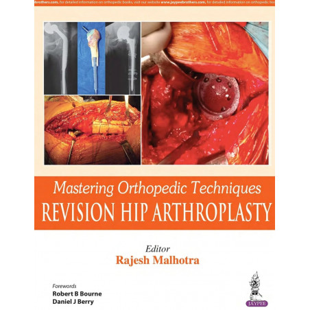 MASTERING ORTHOPEDIC TECHNIQUES REVISION HIP ARTHROPLASTY book by Malhotra Rajesh