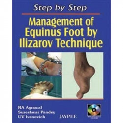 Step by Step Management of Equinus Foot by Ilizarov Technique with Interactive CD-ROM book by Agrawal