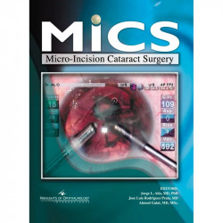 MICS Micro-Incision Cataract Surgery(with CD-ROM) book by Alio