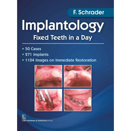 IMPLANTOLOGY FIXED TEETH IN A DAY (PB 2017) book by SCHRADER