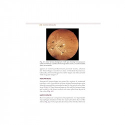Diabetic Retinopathy from Glycemia to Retina (PB 2027) book by Vikas Ambiya - Additional Image 8