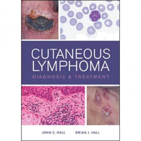 Cutaneous Lymphoma Diagnosis and Treatment book by John C. Hall, Brian Hall