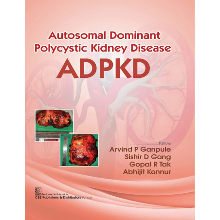 Autosomal Dominant Polytechnic Kidney Disease ADPKD book by Arvind Ganpule