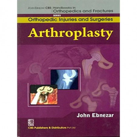 ARTHROPLASTY (HANDBOOKS IN ORTHOPEDICS AND FRACTURES SERIES VOL 62 ORTHOPEDIC INJURIES AND SURGERIES (2012): Orthopedic Inju…
