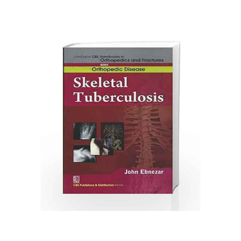 John Ebnezar CBS Handbooks in Orthopedics and Factures: Orthopedic Disease: Skeletal Tuberculosis by Ebnezar J. Book-97881239211