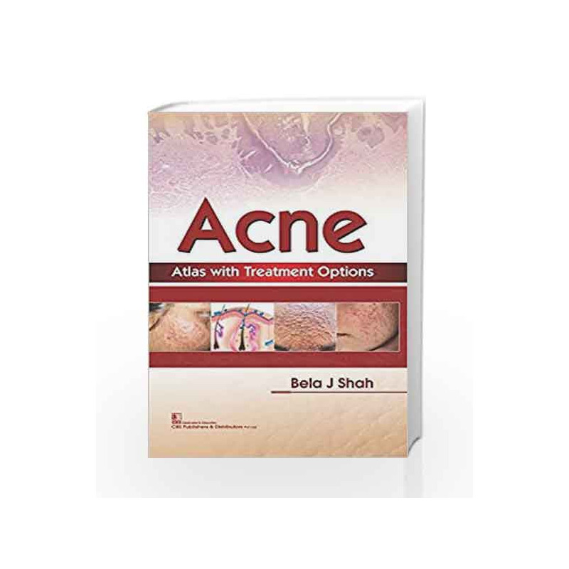 Acne Atlas With Treatment Options (Hb 2018) by Shah B J Book-9789387085046