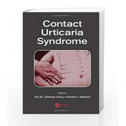 Contact Urticaria Syndrome by Gimenez-Arnau A M Book-9781466598003
