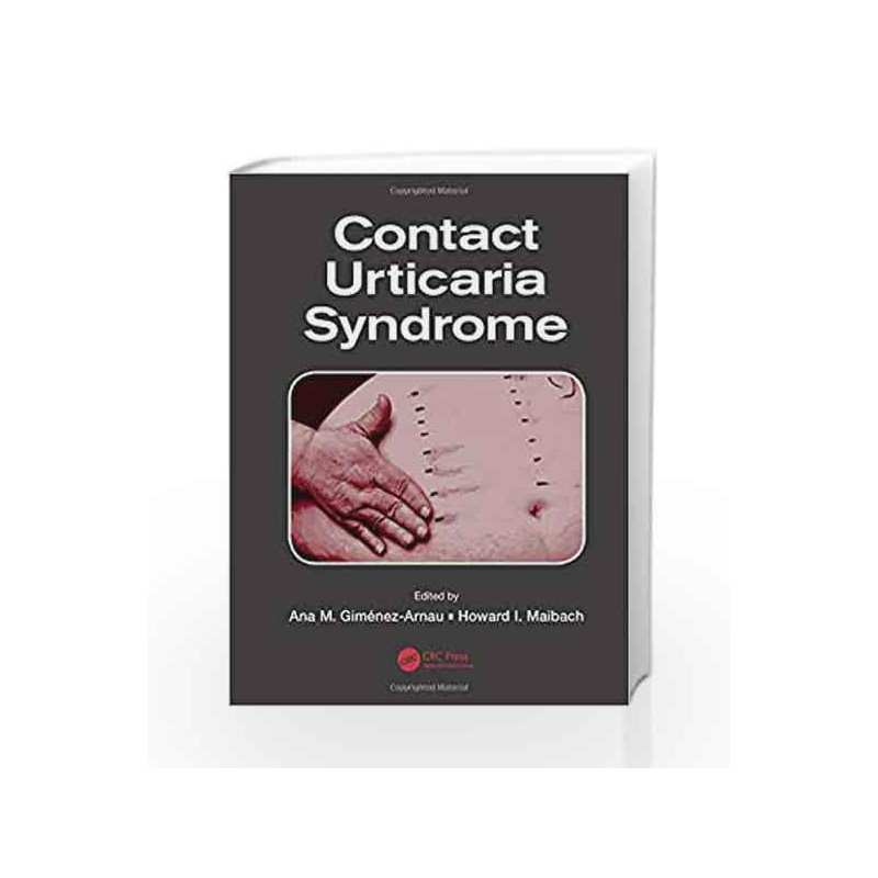 Contact Urticaria Syndrome by Gimenez-Arnau A M Book-9781466598003