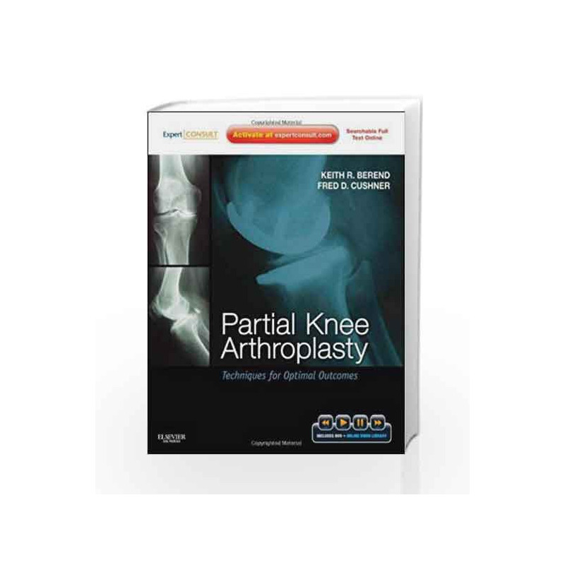 Partial Knee Arthroplasty: Techniques for Optimal Outcomes with DVD