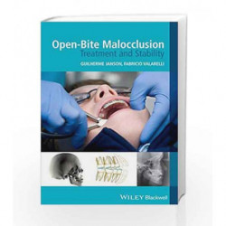 OpenBite Malocclusion: Treatment and Stability by Janson Book-9781118335987