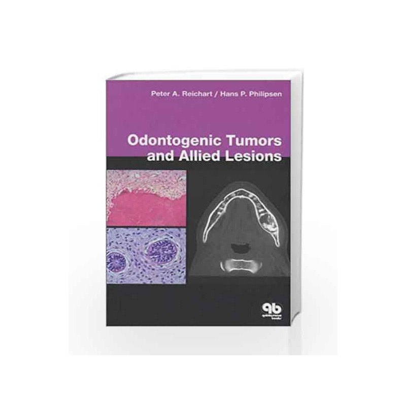 Odontogenic Tumours and Allied Lesions by Reichart Book-9781850970590