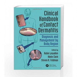 Clinical Handbook of Contact Dermatitis: Diagnosis and Management by Body Region by Lewallen Book-9781482237177