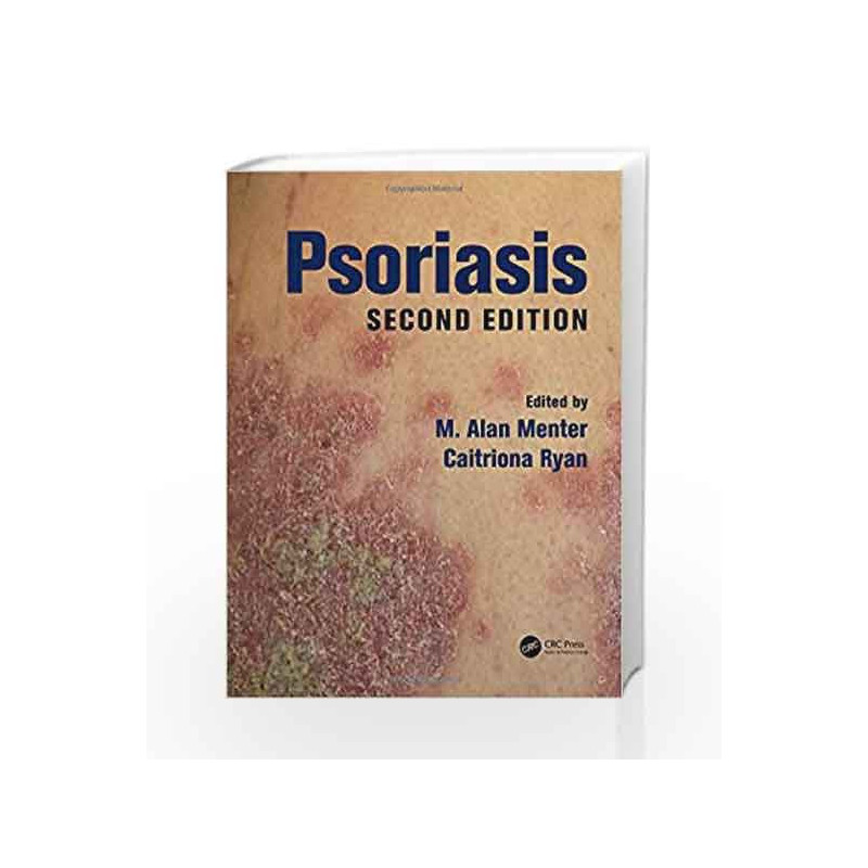 Psoriasis by Menter M A Book-9781498700528