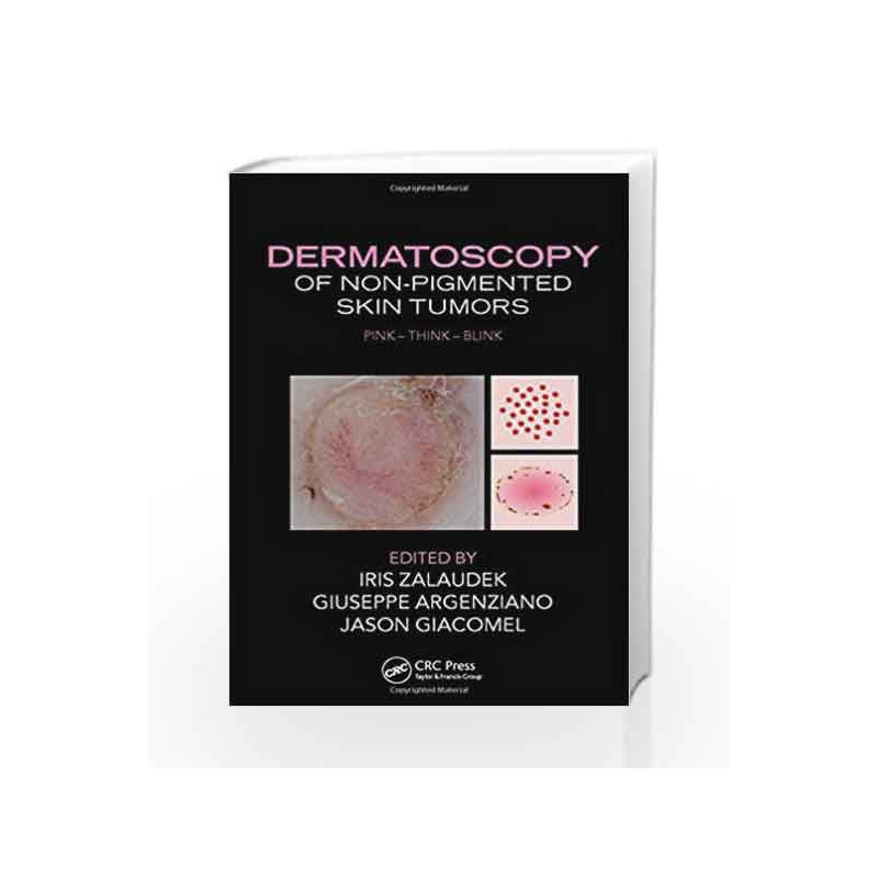 Dermatoscopy of Non-Pigmented Skin Tumors: Pink - Think - Blink by Zalaudek I Book-9781482237528