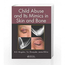 Child Abuse and its Mimics in Skin and Bone by Brogdon B.G Book-9781439855355
