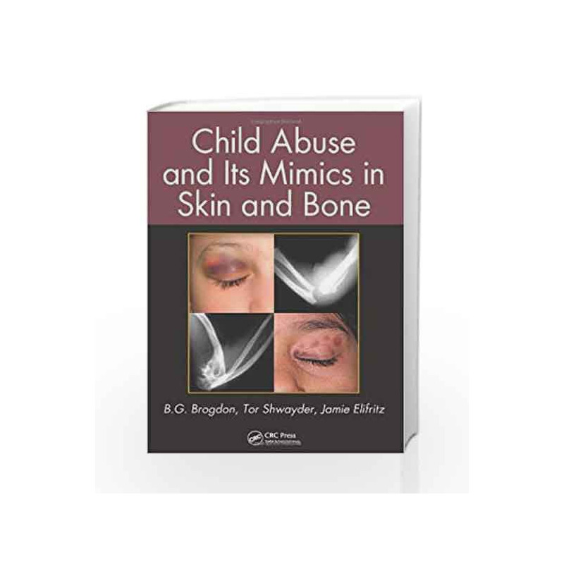 Child Abuse and its Mimics in Skin and Bone by Brogdon B.G Book-9781439855355