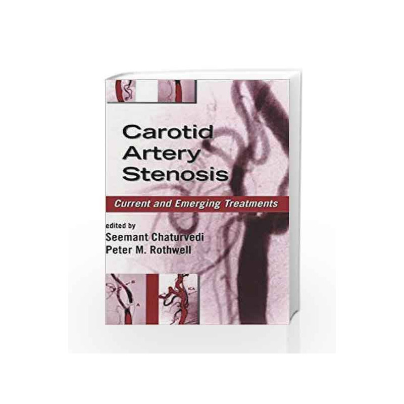 Carotid Artery Stenosis: Current and Emerging Treatments (Neurological Disease and Therapy) by Bayindirli Book-9780824754174