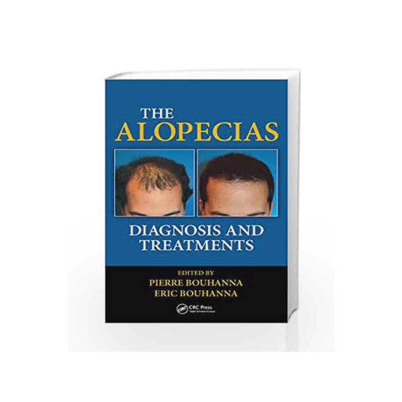 The Alopecias: Diagnosis and Treatments by Bouhanna P Book-9781482212754