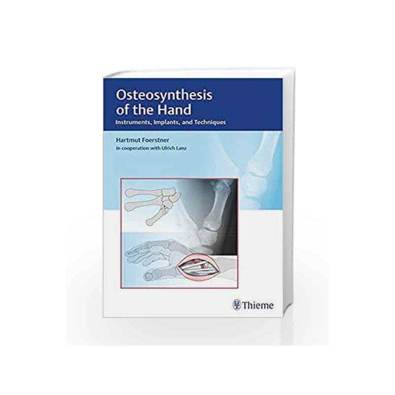 Osteosynthesis of the Hand: Instruments, Implants, and Techniques by Foerstner H. Book-9783132038110