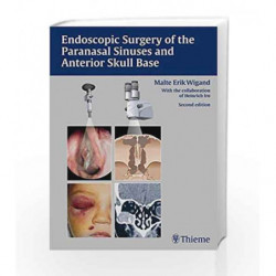 Endoscopic Surgery of the Paranasal Sinuses and Anterior Skull Base by Wigand Book-9783137494027