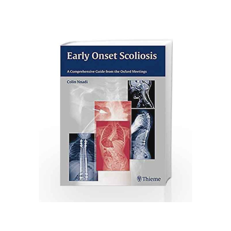 Early Onset Scoliosis: A Comprehensive Guide from the Oxford Meetings by Nnadi C. Book-9783131726612